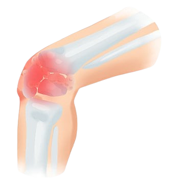 knee-pain